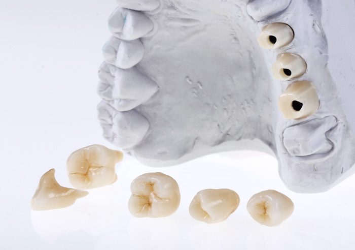 IndividuelleAbutments beiImplantatversorgung 